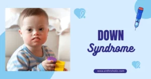 Down Syndrome (Trisomy 21) in Biological Anthropology