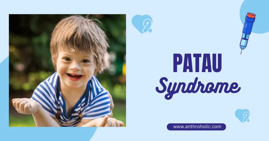 Patau Syndrome (Trisomy 13) in Biological Anthropology