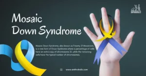 Mosaic Down Syndrome, also known as Trisomy 21 Mosaicism, is a rare form of Down Syndrome where a percentage of cells have an extra copy of chromosome 21, while the remaining cells have the typical number of chromosomes.
